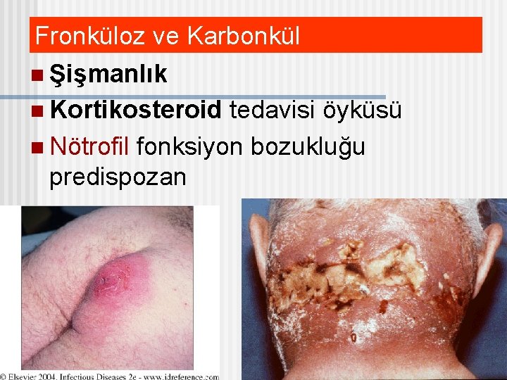 Fronküloz ve Karbonkül n Şişmanlık n Kortikosteroid tedavisi öyküsü n Nötrofil fonksiyon bozukluğu predispozan