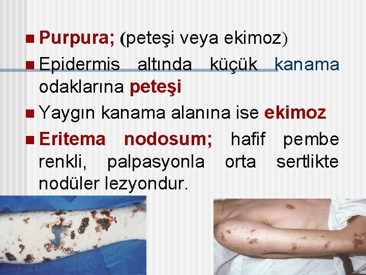 n Purpura; (peteşi veya ekimoz) n Epidermis altında küçük kanama odaklarına peteşi n Yaygın