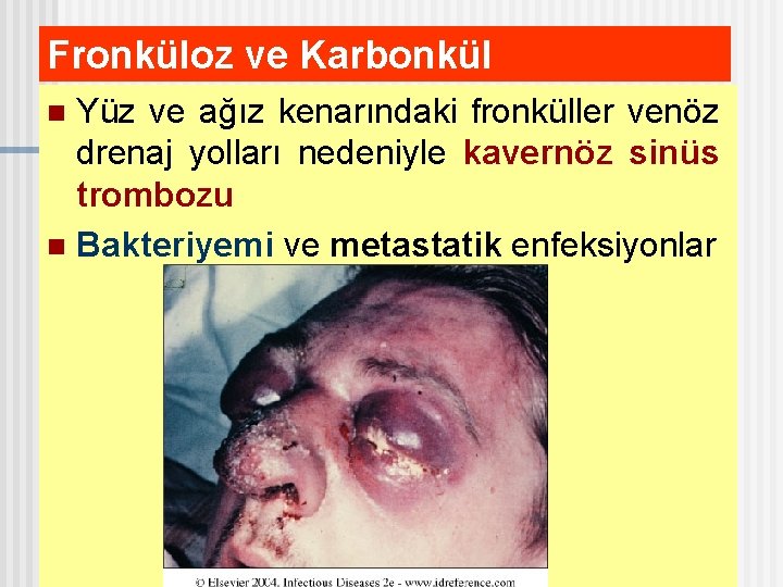 Fronküloz ve Karbonkül Yüz ve ağız kenarındaki fronküller venöz drenaj yolları nedeniyle kavernöz sinüs