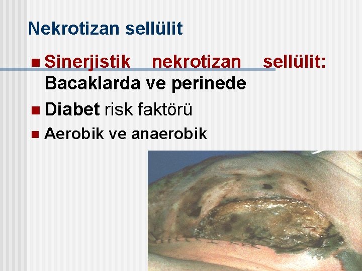 Nekrotizan sellülit n Sinerjistik nekrotizan sellülit: Bacaklarda ve perinede n Diabet risk faktörü n