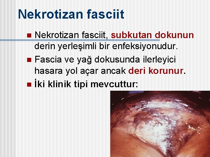 Nekrotizan fasciit, subkutan dokunun derin yerleşimli bir enfeksiyonudur. n Fascia ve yağ dokusunda ilerleyici