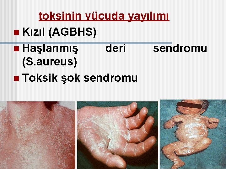 toksinin vücuda yayılımı n Kızıl (AGBHS) n Haşlanmış deri sendromu (S. aureus) n Toksik
