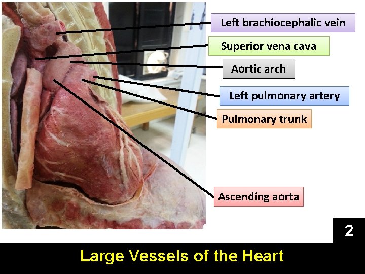 Left brachiocephalic vein Superior vena cava Aortic arch Left pulmonary artery Pulmonary trunk Ascending