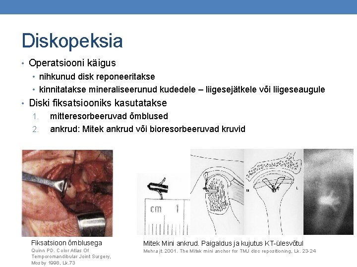 Diskopeksia • Operatsiooni käigus • nihkunud disk reponeeritakse • kinnitatakse mineraliseerunud kudedele – liigesejätkele