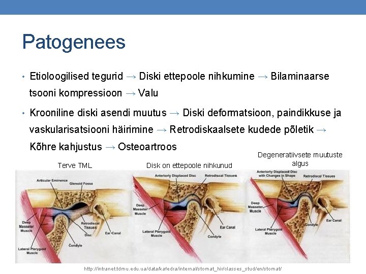 Patogenees • Etioloogilised tegurid → Diski ettepoole nihkumine → Bilaminaarse tsooni kompressioon → Valu