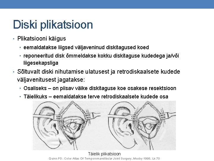 Diski plikatsioon • Plikatsiooni käigus • eemaldatakse liigsed väljaveninud diskitagused koed • reponeeritud disk