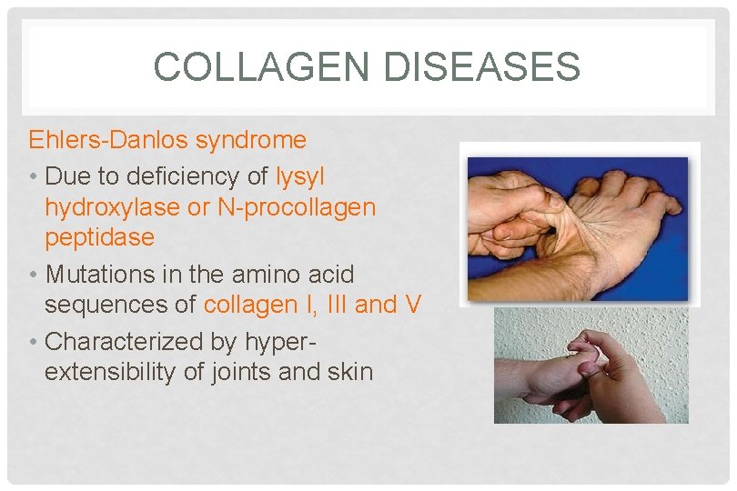 COLLAGEN DISEASES Ehlers-Danlos syndrome • Due to deficiency of lysyl hydroxylase or N-procollagen peptidase