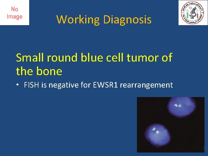 Working Diagnosis Small round blue cell tumor of the bone • FISH is negative