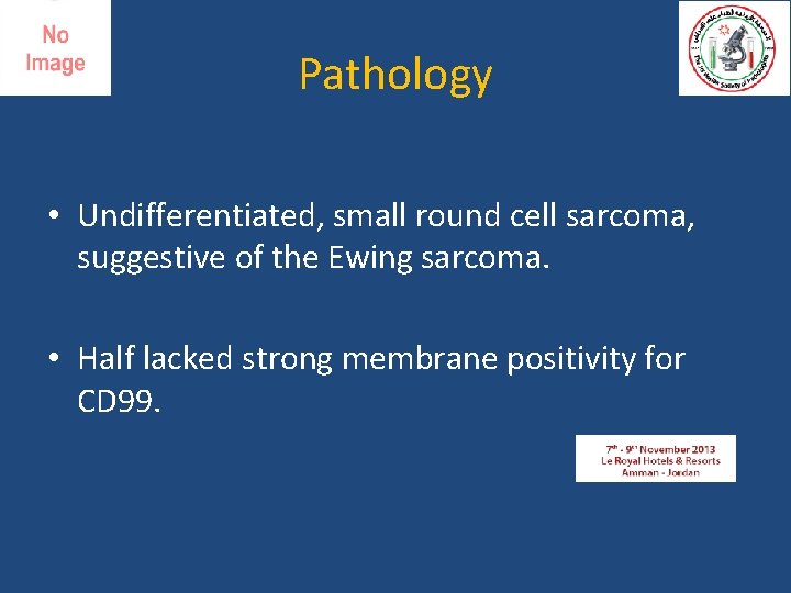 Pathology • Undifferentiated, small round cell sarcoma, suggestive of the Ewing sarcoma. • Half