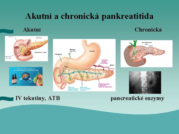 Akutní a chronická pankreatitida Akutní IV tekutiny, ATB Chronická pancreatické enzymy 