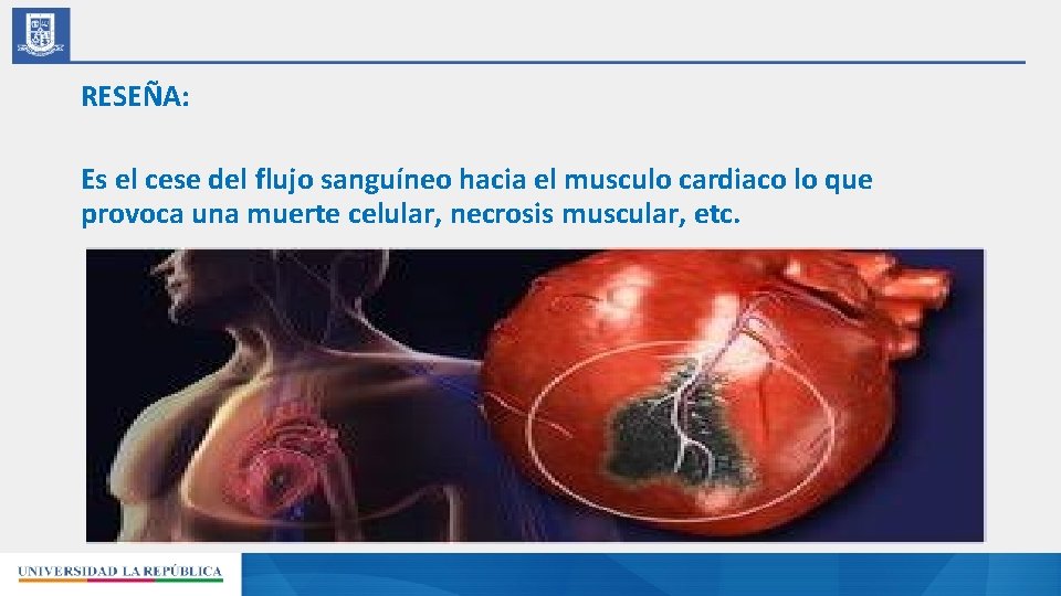 RESEÑA: Es el cese del flujo sanguíneo hacia el musculo cardiaco lo que provoca