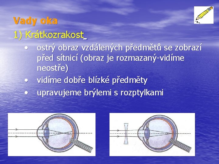 Vady oka 1) Krátkozrakost • ostrý obraz vzdálených předmětů se zobrazí před sítnicí (obraz