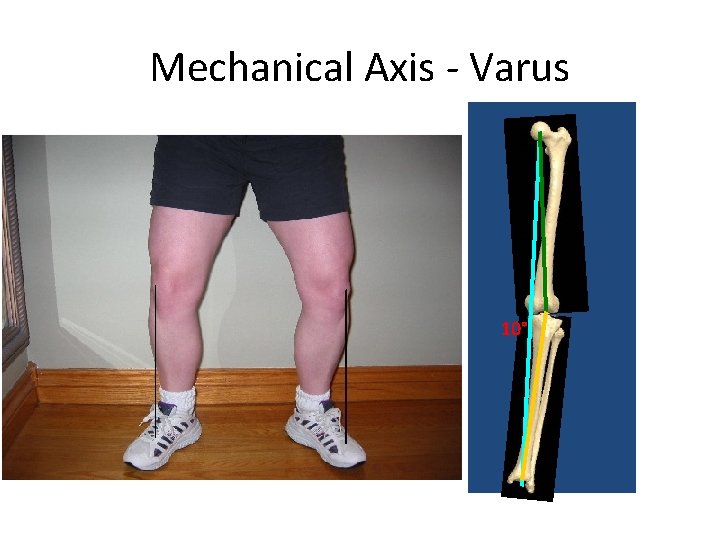 Mechanical Axis - Varus 10° 