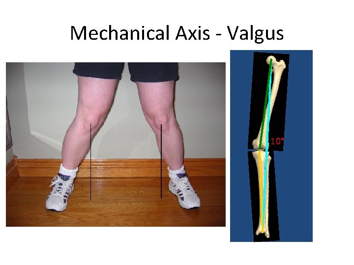 Mechanical Axis - Valgus 10° 