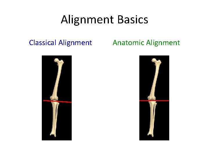 Alignment Basics Classical Alignment Anatomic Alignment 