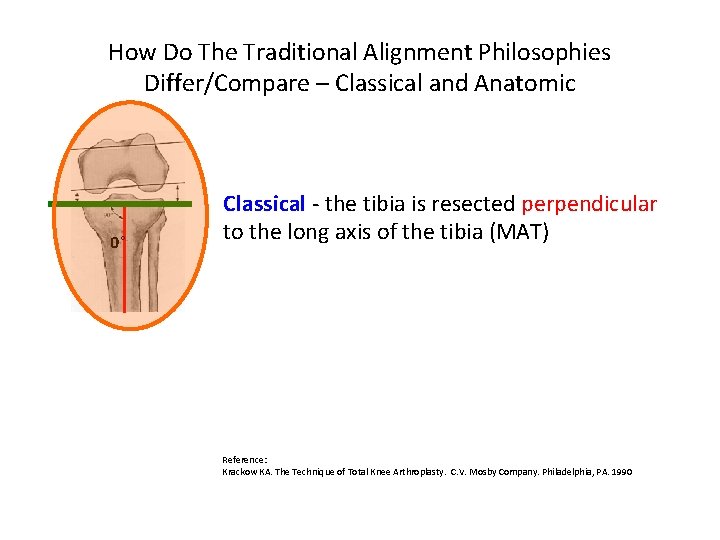 How Do The Traditional Alignment Philosophies Differ/Compare – Classical and Anatomic 0° Classical -