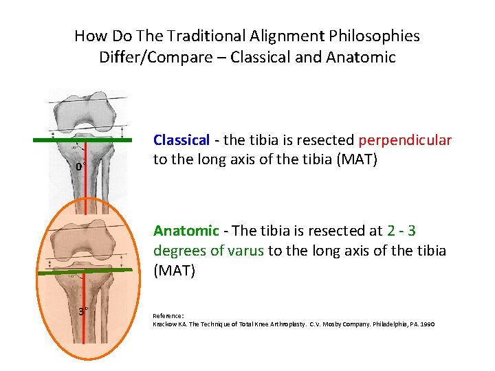 How Do The Traditional Alignment Philosophies Differ/Compare – Classical and Anatomic 0° Classical -