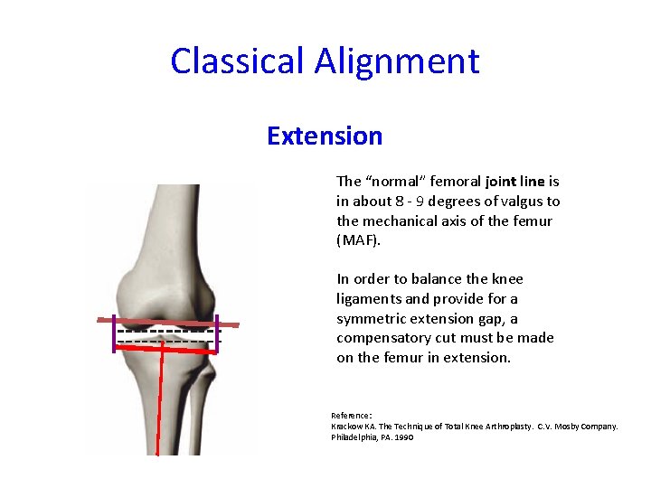 Classical Alignment Extension The “normal” femoral joint line is in about 8 - 9
