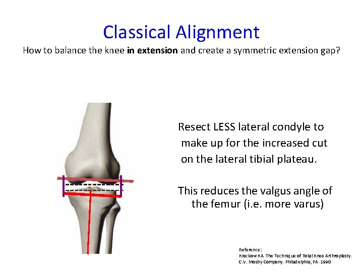 Classical Alignment How to balance the knee in extension and create a symmetric extension