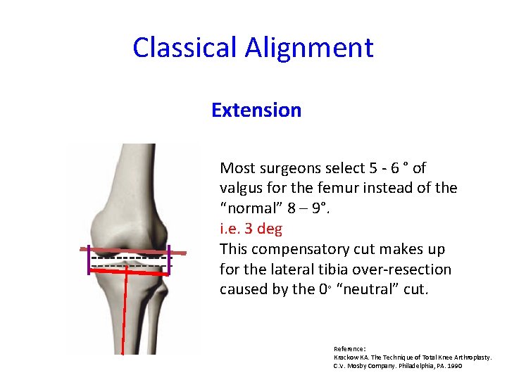 Classical Alignment Extension Most surgeons select 5 - 6 ° of valgus for the