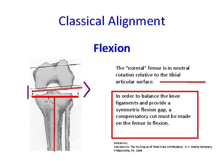 Classical Alignment Flexion The “normal” femur is in neutral rotation relative to the tibial