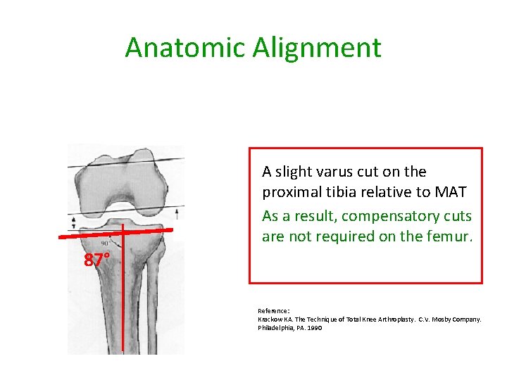 Anatomic Alignment A slight varus cut on the proximal tibia relative to MAT As