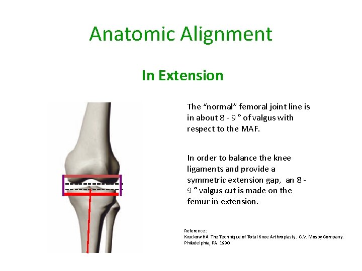 Anatomic Alignment In Extension The “normal” femoral joint line is in about 8 -