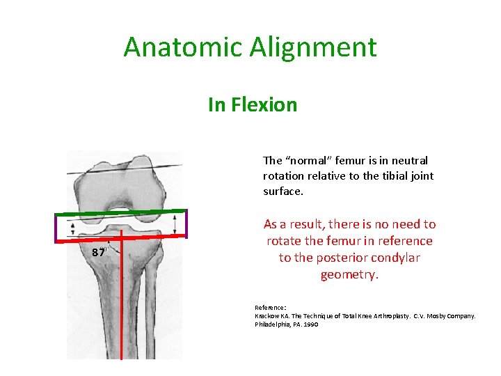 Anatomic Alignment In Flexion The “normal” femur is in neutral rotation relative to the