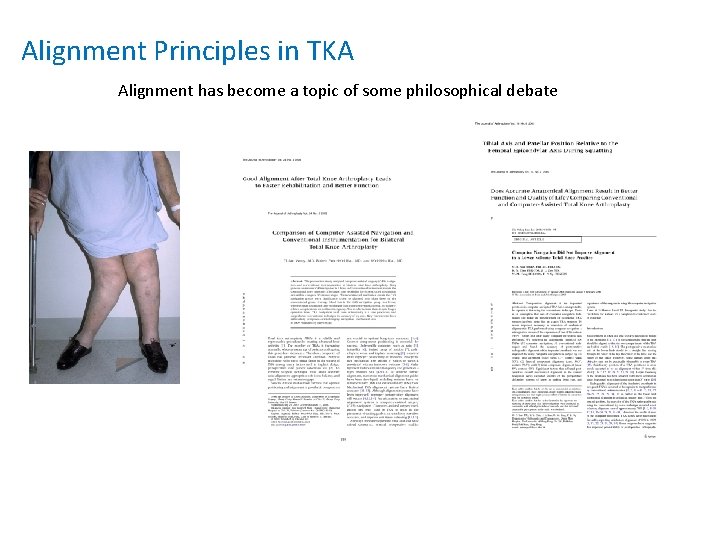 Alignment Principles in TKA Alignment has become a topic of some philosophical debate 