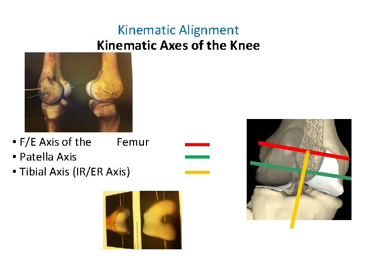Kinematic Alignment Kinematic Axes of the Knee • F/E Axis of the Femur •
