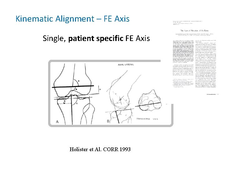 Kinematic Alignment – FE Axis Single, patient specific FE Axis Holister et Al. CORR