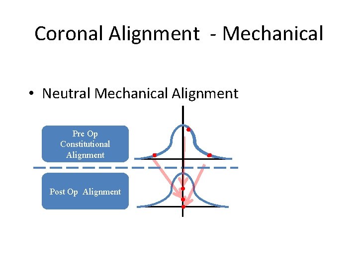 Coronal Alignment - Mechanical • Neutral Mechanical Alignment Pre Op Constitutional Alignment Post Op