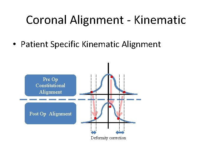 Coronal Alignment - Kinematic • Patient Specific Kinematic Alignment Pre Op Constitutional Alignment Post