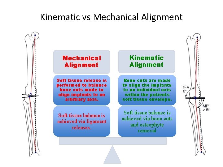 Kinematic vs Mechanical Alignment Kinematic Alignment Soft tissue release is performed to balance bone