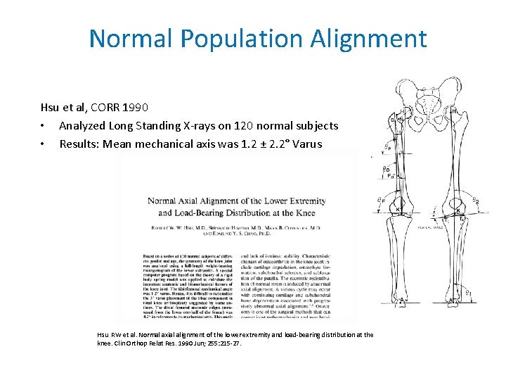 Normal Population Alignment Hsu et al, CORR 1990 • Analyzed Long Standing X-rays on