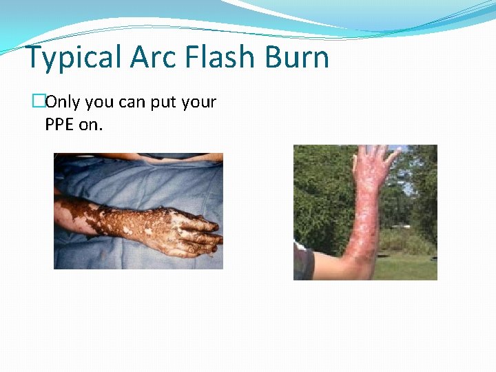 Typical Arc Flash Burn �Only you can put your PPE on. 