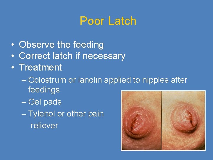 Poor Latch • Observe the feeding • Correct latch if necessary • Treatment –