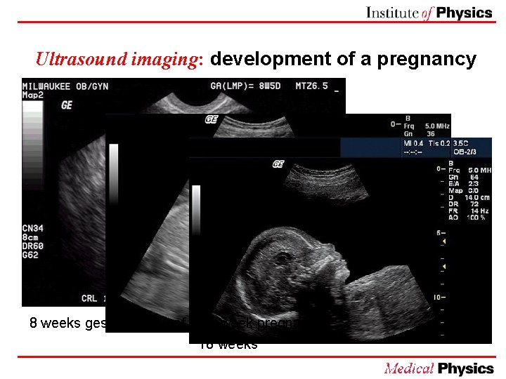 Ultrasound imaging: development of a pregnancy 24 weeks 8 weeks gestation (out of a