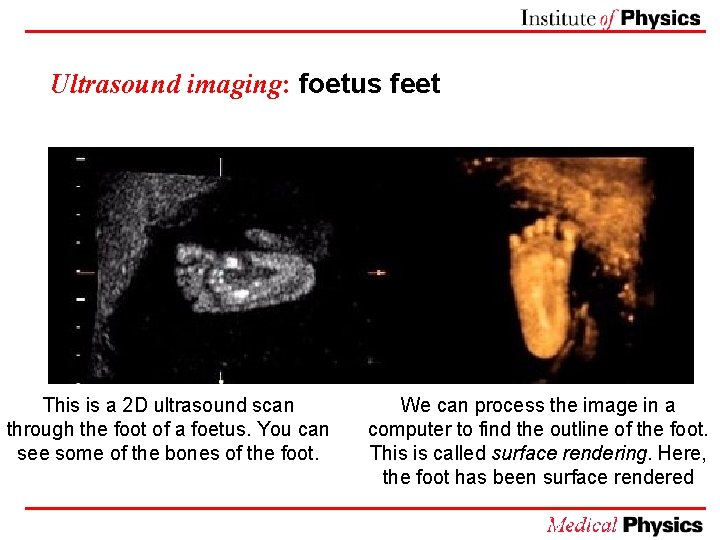 Ultrasound imaging: foetus feet This is a 2 D ultrasound scan through the foot