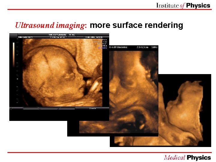 Ultrasound imaging: more surface rendering 