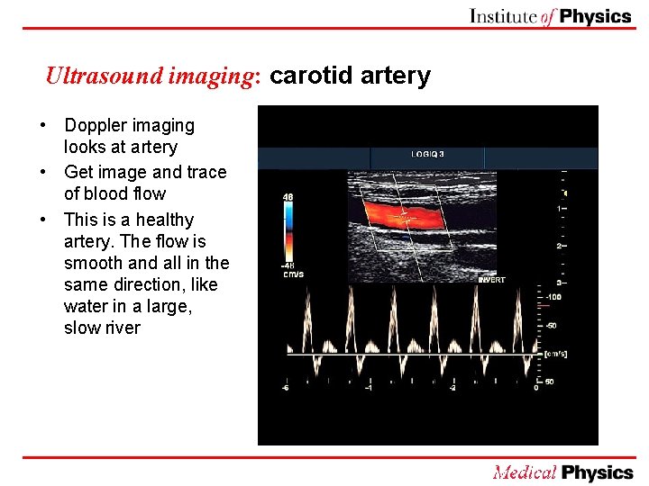 Ultrasound imaging: carotid artery • Doppler imaging looks at artery • Get image and