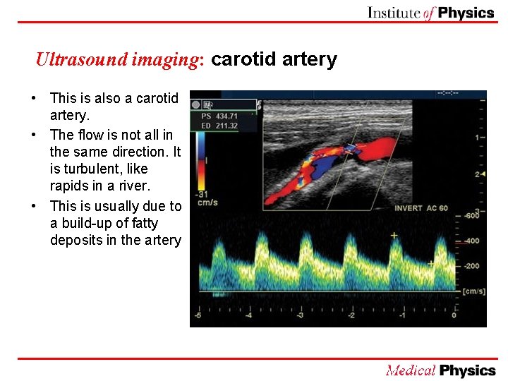 Ultrasound imaging: carotid artery • This is also a carotid artery. • The flow