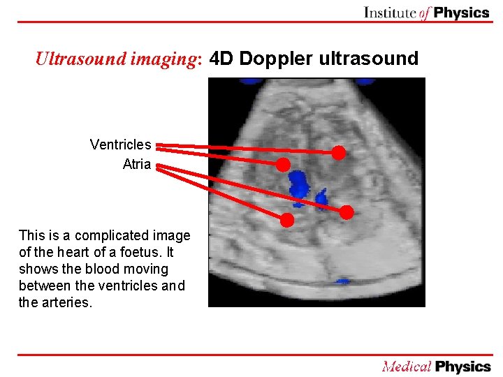 Ultrasound imaging: 4 D Doppler ultrasound Ventricles Atria This is a complicated image of