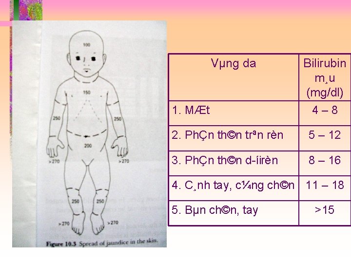 Vµng da 1. MÆt Bilirubin m¸u (mg/dl) 4– 8 2. PhÇn th©n trªn rèn