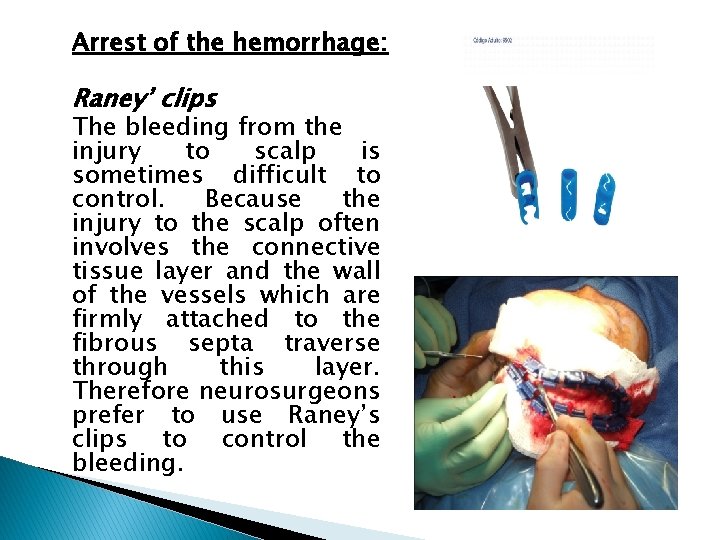 Arrest of the hemorrhage: Raney’ clips The bleeding from the injury to scalp is