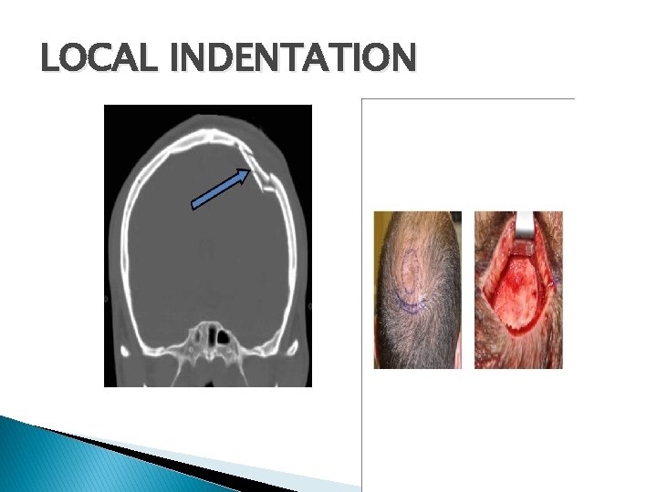 LOCAL INDENTATION 
