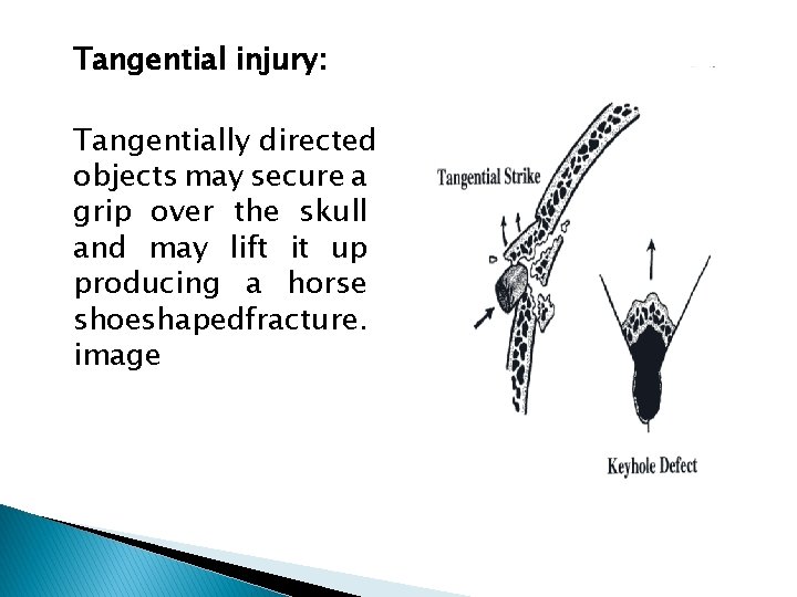Tangential injury: Tangentially directed objects may secure a grip over the skull and may