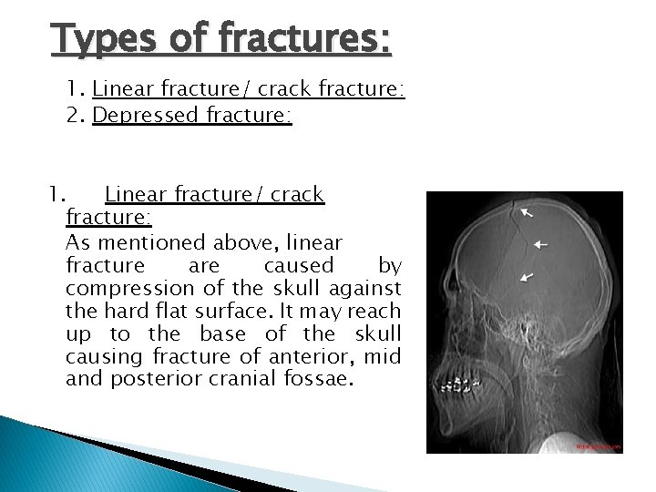 Types of fractures: 1. Linear fracture/ crack fracture: 2. Depressed fracture: 1. Linear fracture/