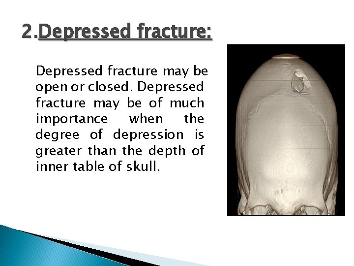 2. Depressed fracture: Depressed fracture may be open or closed. Depressed fracture may be