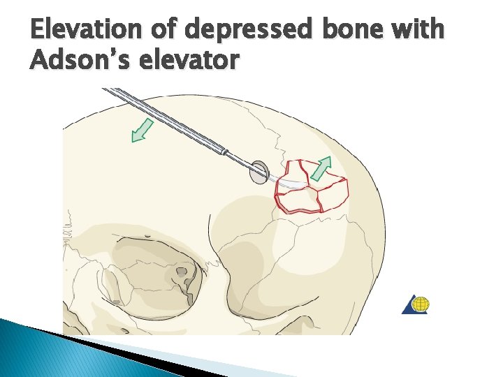 Elevation of depressed bone with Adson’s elevator 